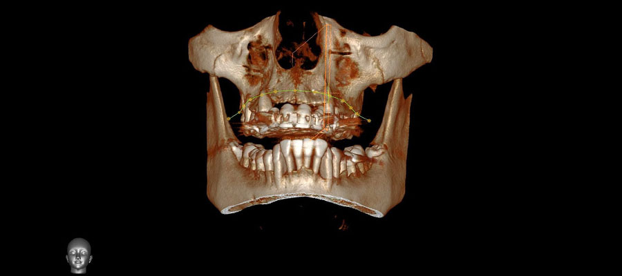 kompyuternaya tomografiya zubov 5