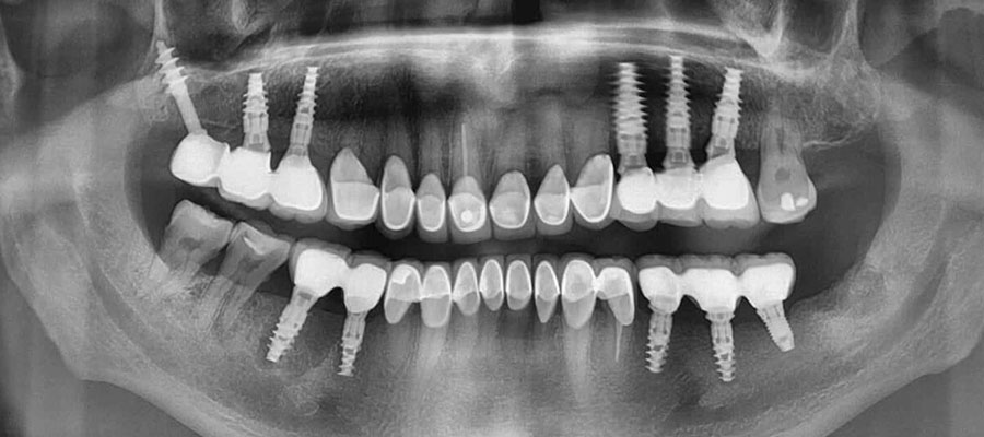 КТ челюсти и имплантация зубов