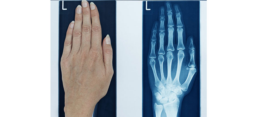 Рентген кистей рук