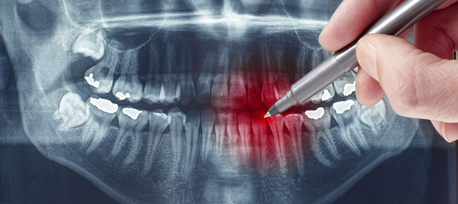 рентген зуба сколько раз можно делать в месяц